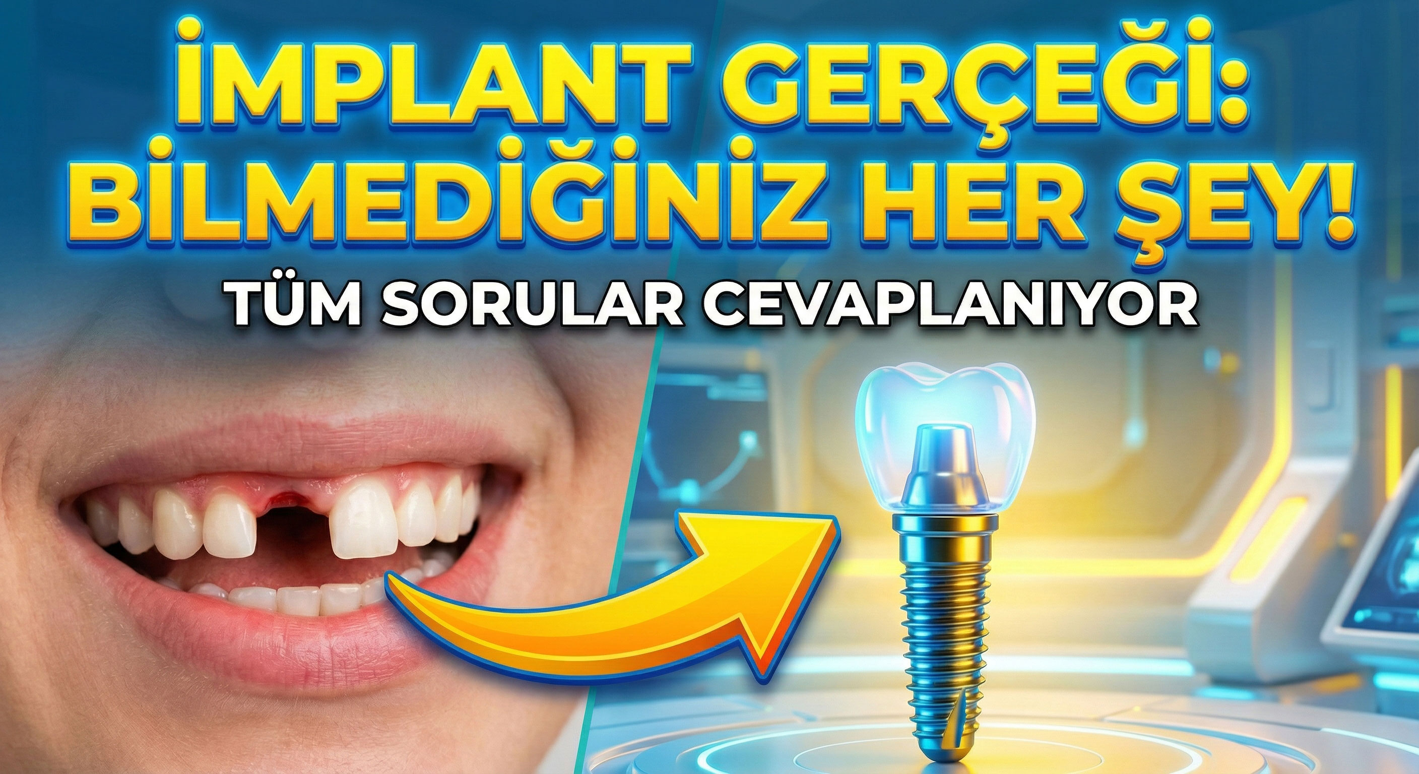 All-on-4 ve All-on-6 ile Bütün Dişlere İmplant Yapımı
