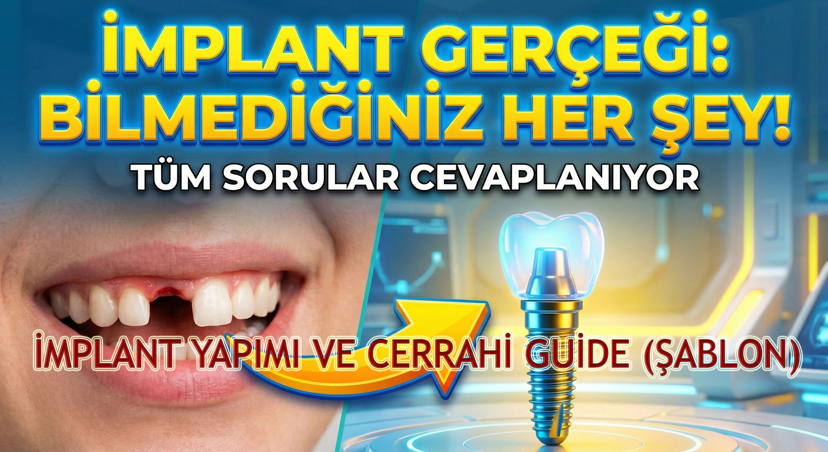 Dikişsiz İmplant Nasıl Yapılır? Avantajları Nelerdir?